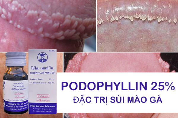 Thuốc Podophyllin 25 Thái Lan điều trị sùi mào gà an toàn tại nhà Thuốc Podophyllin 25 Thái Lan điều trị sùi mào gà an toàn tại nhà